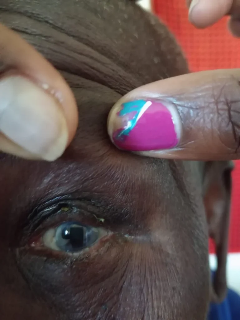 Close-up image showing Napolo’s healing eyelids after trachoma surgery, with no signs of irritation or discomfort. 