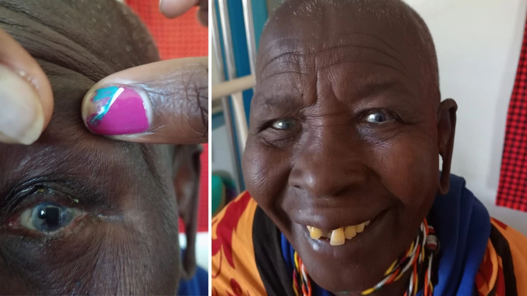 Two images are displayed side by side. One shows the closeup of an eye with no eyelashes. A second image shows a Maasai woman smiling at the camera. 